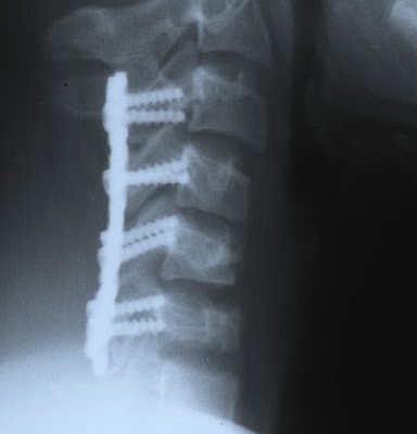 Frattura delle vertebre cervicali